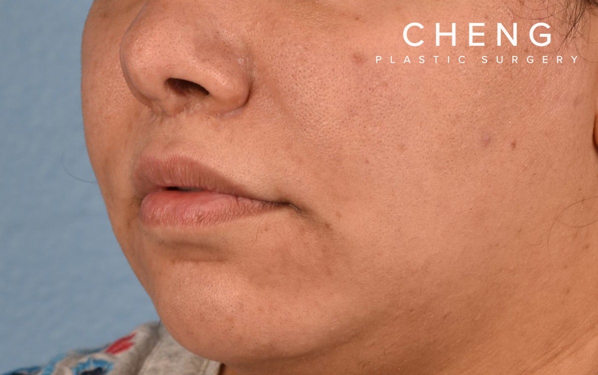 Hidden Patients Before & After Gallery - Patient 279952 - Image 6