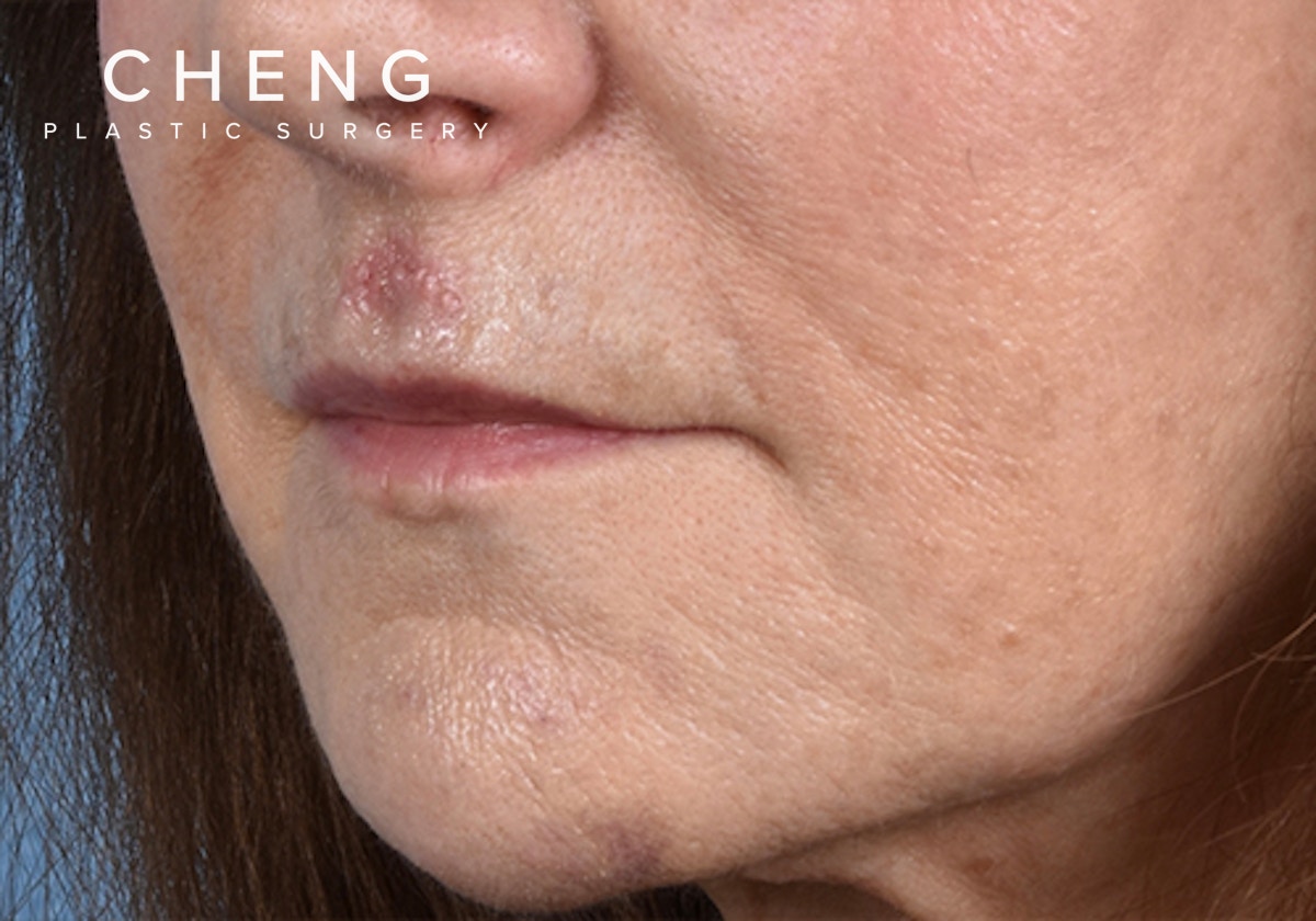 Hidden Patients Before & After Gallery - Patient 294842 - Image 1