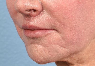 Hidden Patients Before & After Gallery - Patient 294842 - Image 2