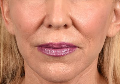 Hidden Patients Before & After Gallery - Patient 320850 - Image 1