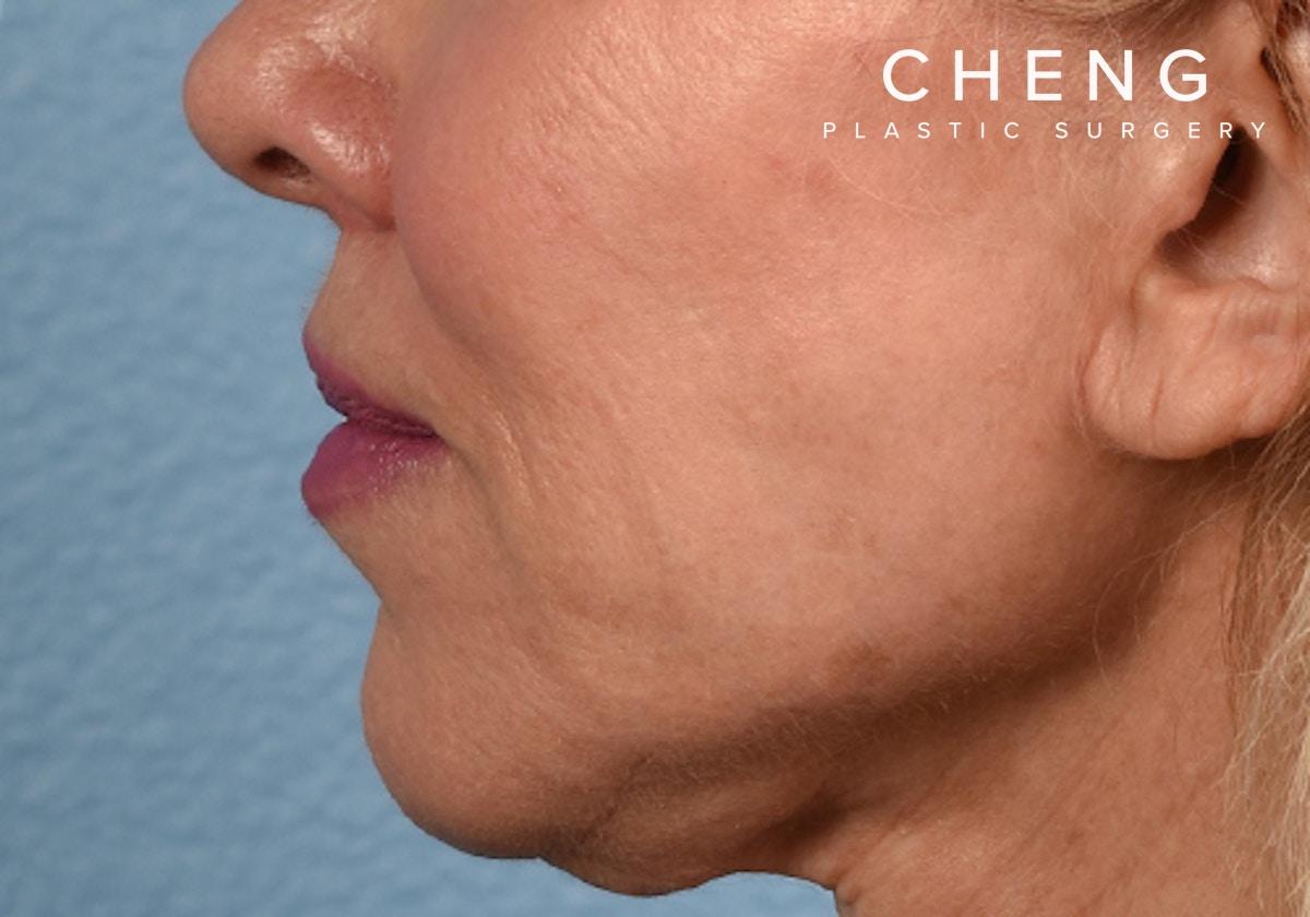 Hidden Patients Before & After Gallery - Patient 320850 - Image 6