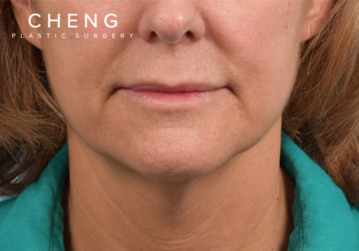 Lip Lift Before & After Gallery - Patient 173901 - Image 1