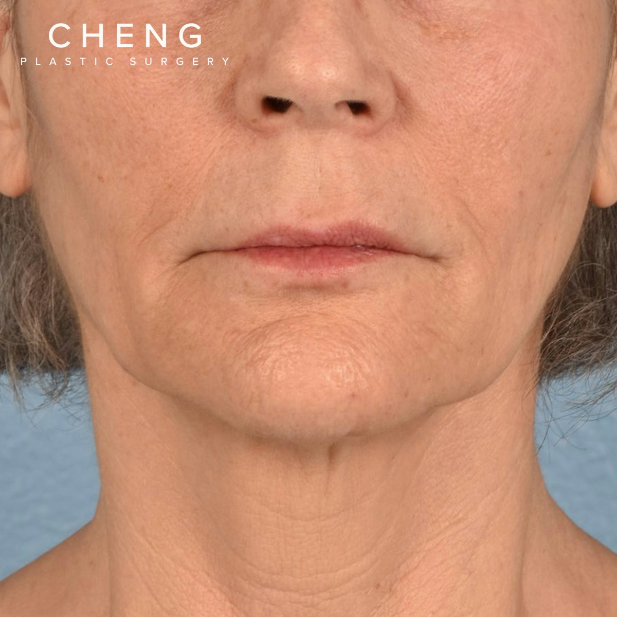 Hidden Patients Before & After Gallery - Patient 165117 - Image 1