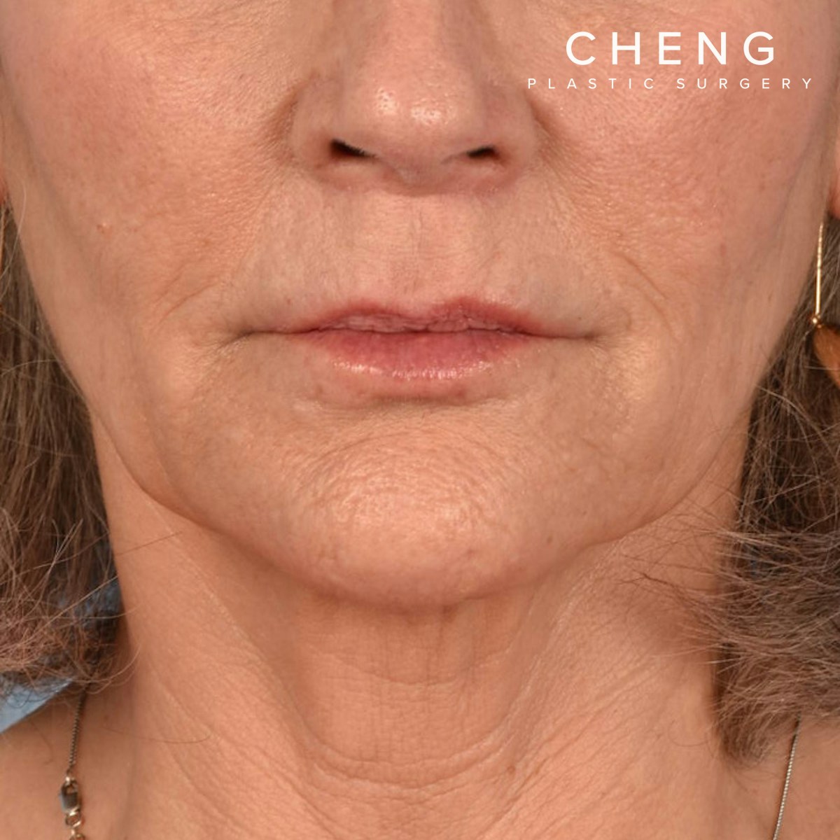 Hidden Patients Before & After Gallery - Patient 165117 - Image 2
