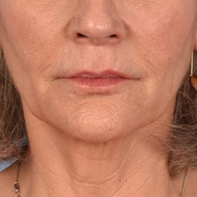 Hidden Patients Before & After Gallery - Patient 165117 - Image 2