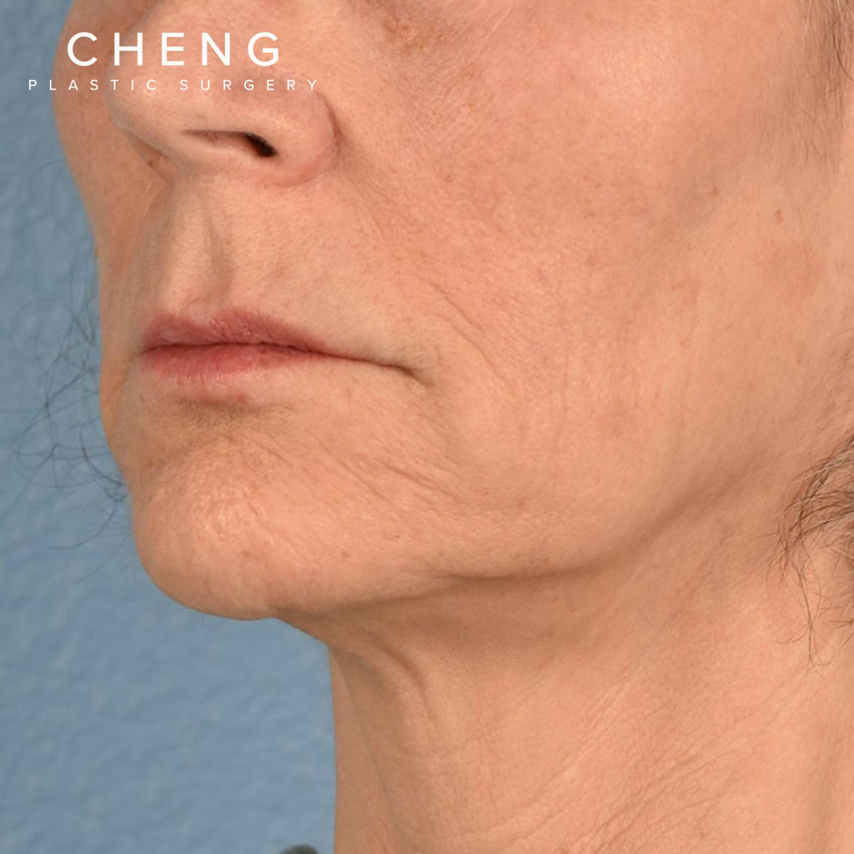 Hidden Patients Before & After Gallery - Patient 165117 - Image 3