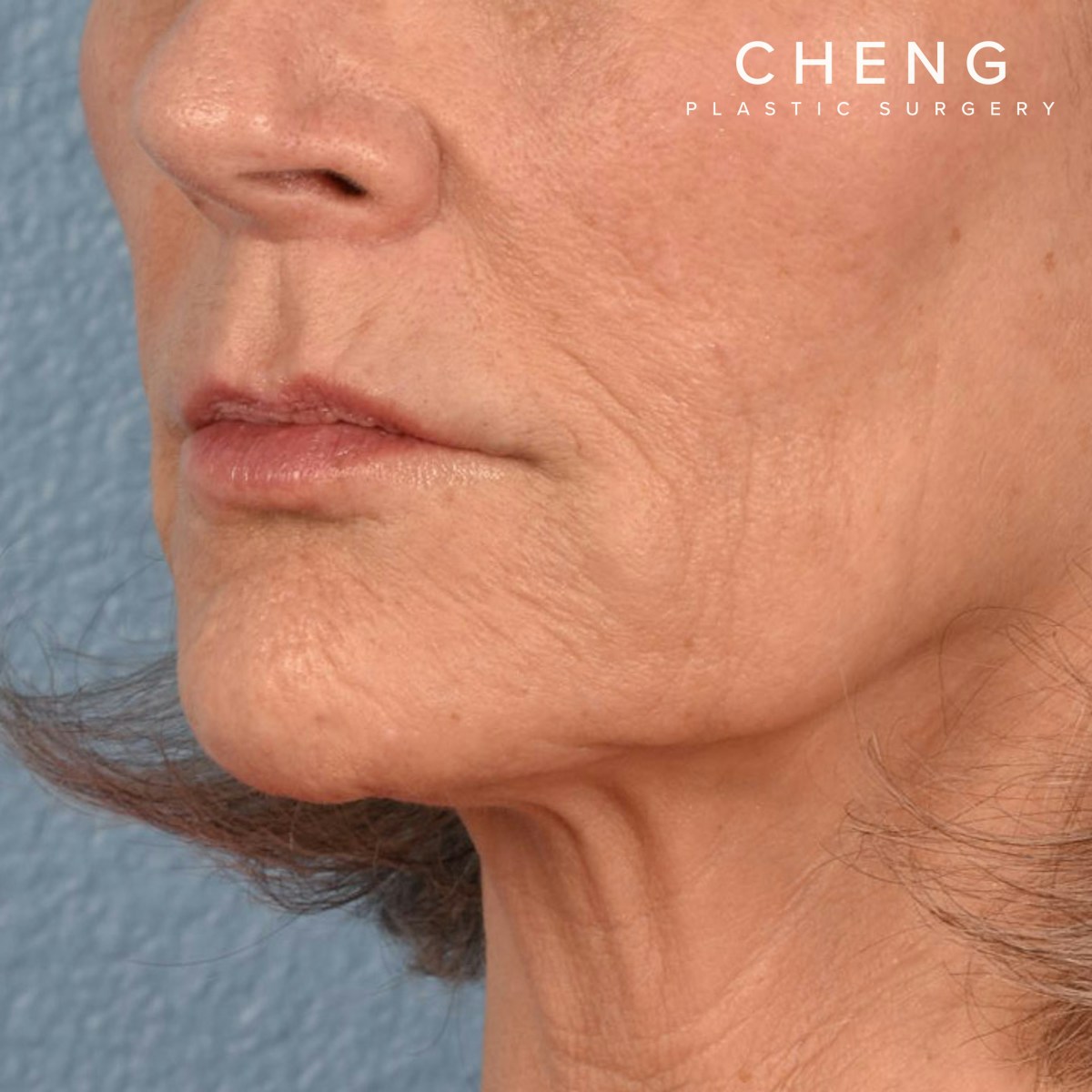 Hidden Patients Before & After Gallery - Patient 165117 - Image 4