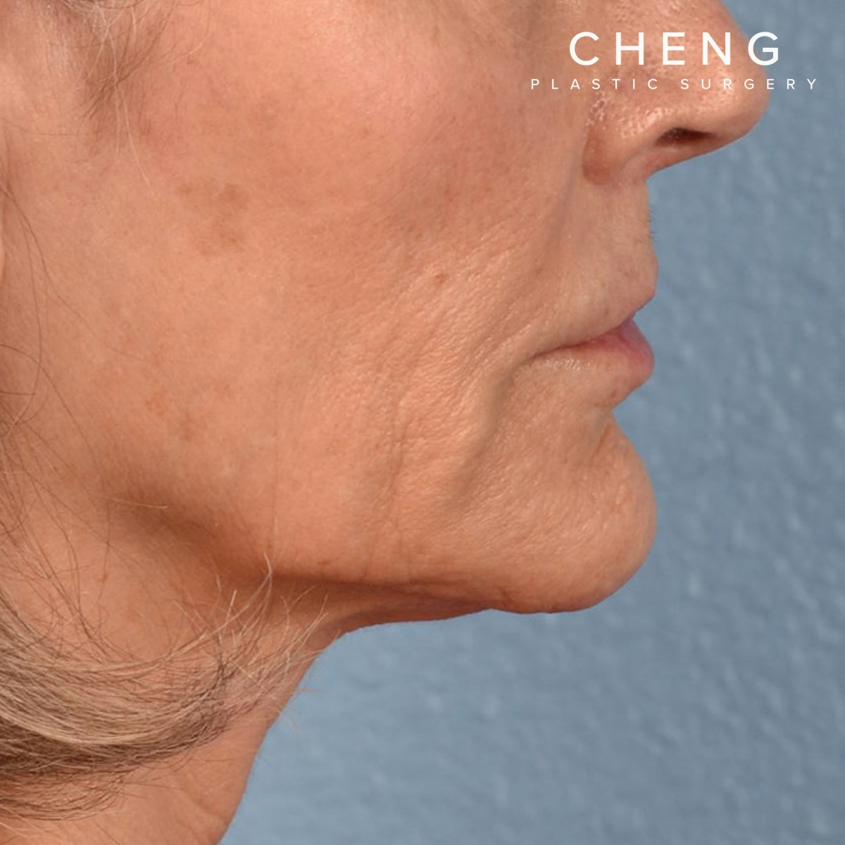 Hidden Patients Before & After Gallery - Patient 165117 - Image 6