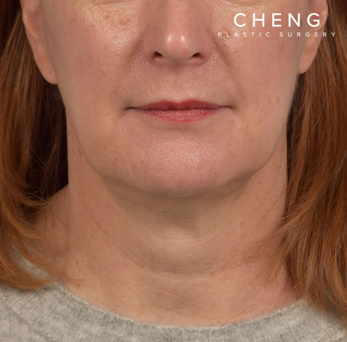 Neck Lift Before & After Gallery - Patient 204140 - Image 2