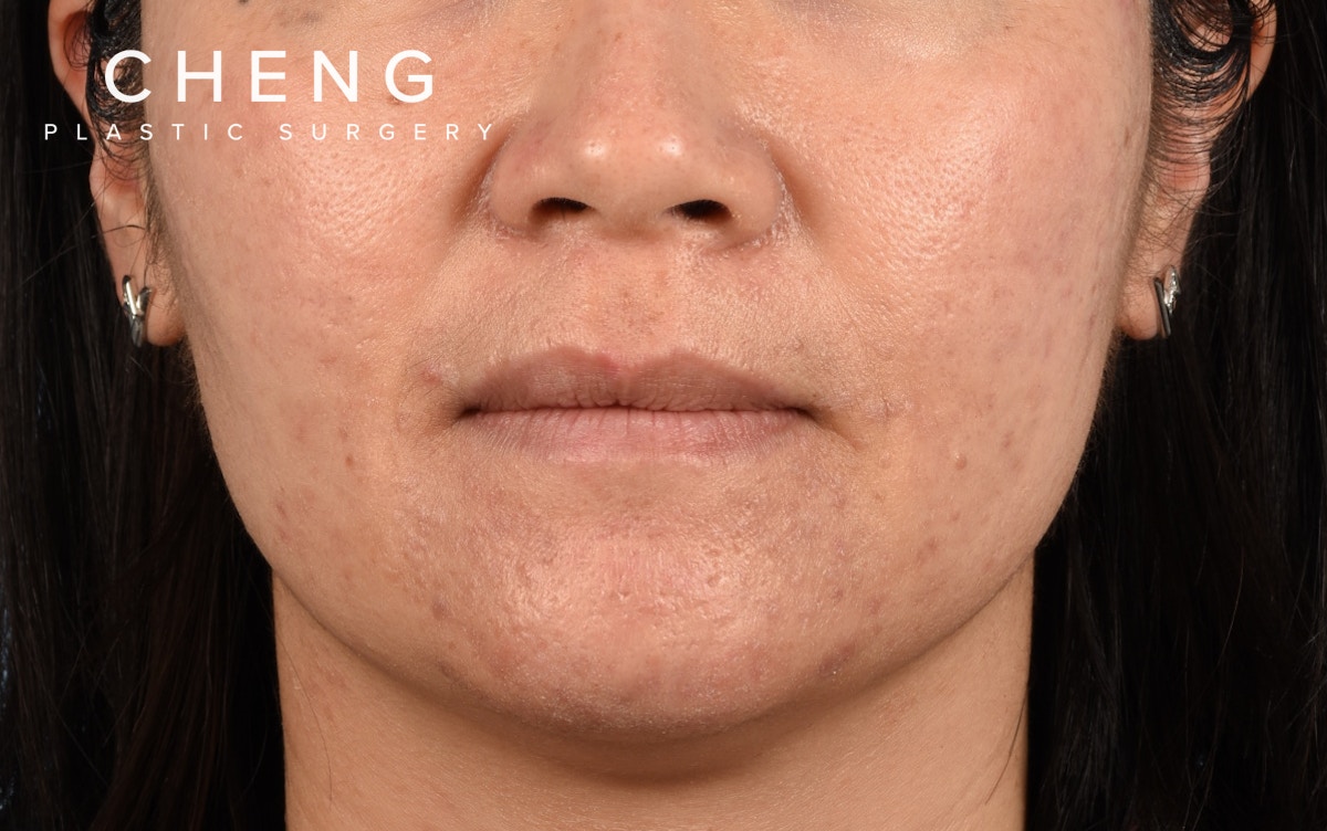 Hidden Patients Before & After Gallery - Patient 376097 - Image 1
