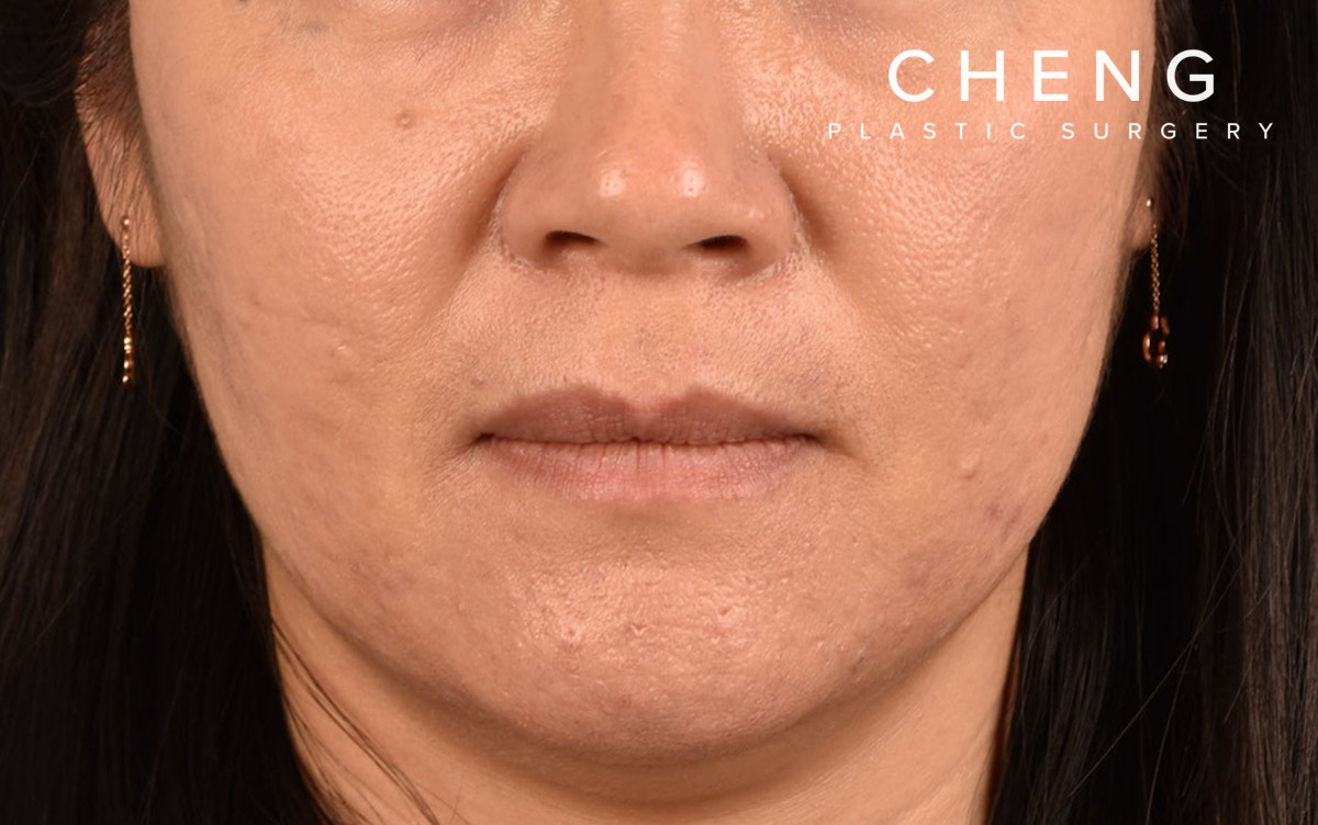 Hidden Patients Before & After Gallery - Patient 376097 - Image 2