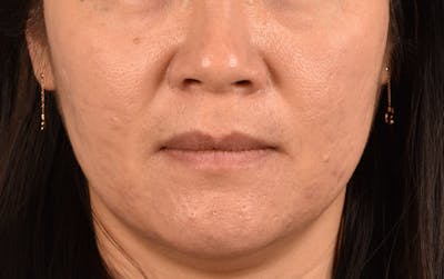 Hidden Patients Before & After Gallery - Patient 376097 - Image 2