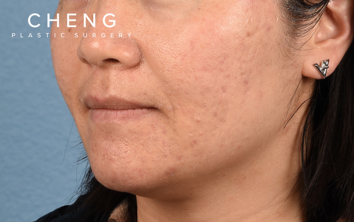 Hidden Patients Before & After Gallery - Patient 376097 - Image 3
