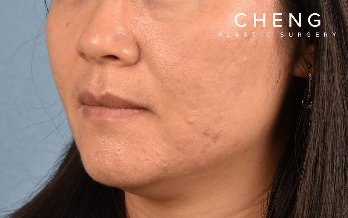 Hidden Patients Before & After Gallery - Patient 376097 - Image 4