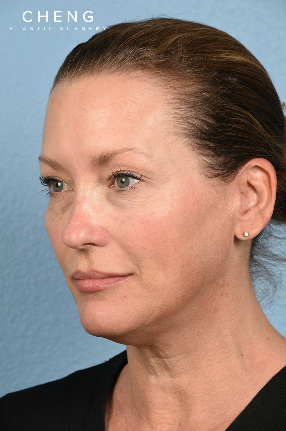 Dermal Fillers Before & After Gallery - Patient 311543 - Image 3