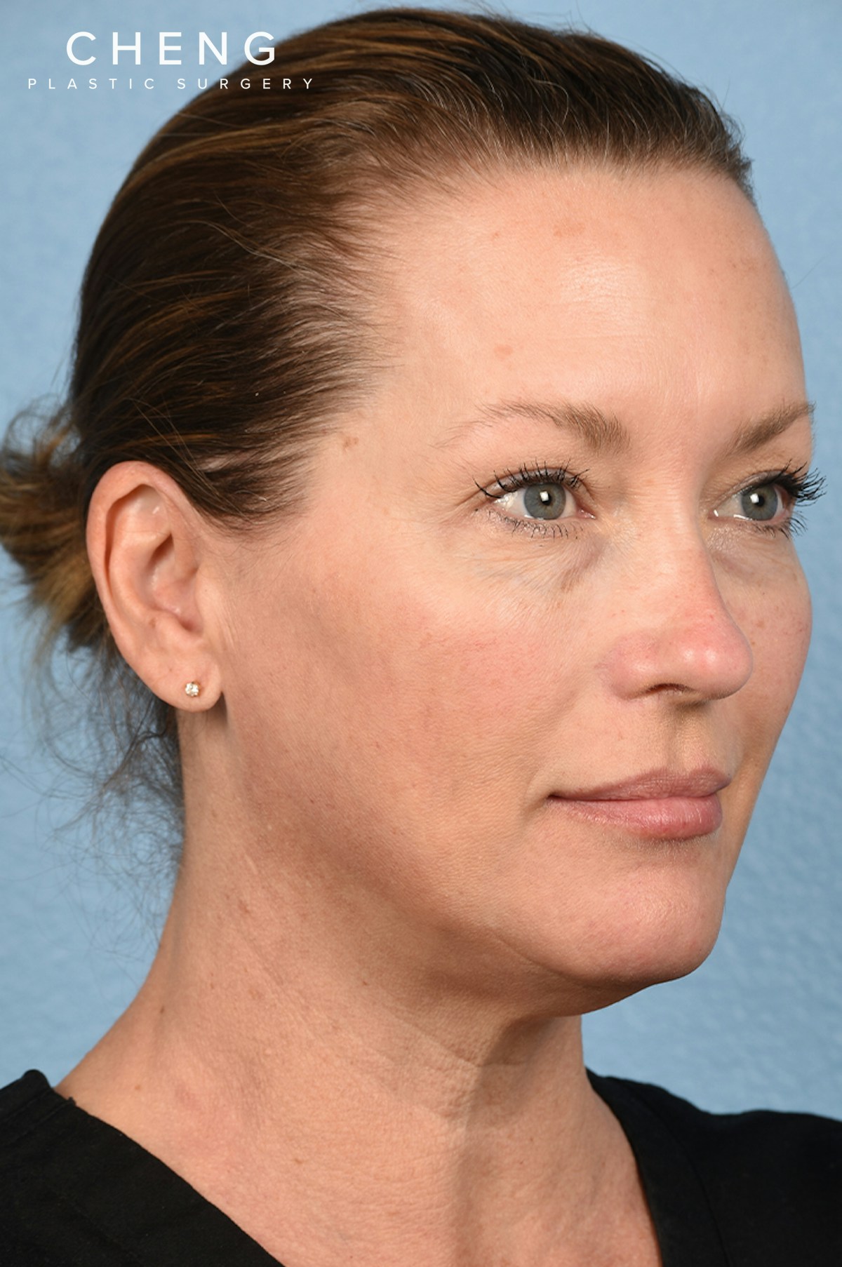 Dermal Fillers Before & After Gallery - Patient 311543 - Image 1