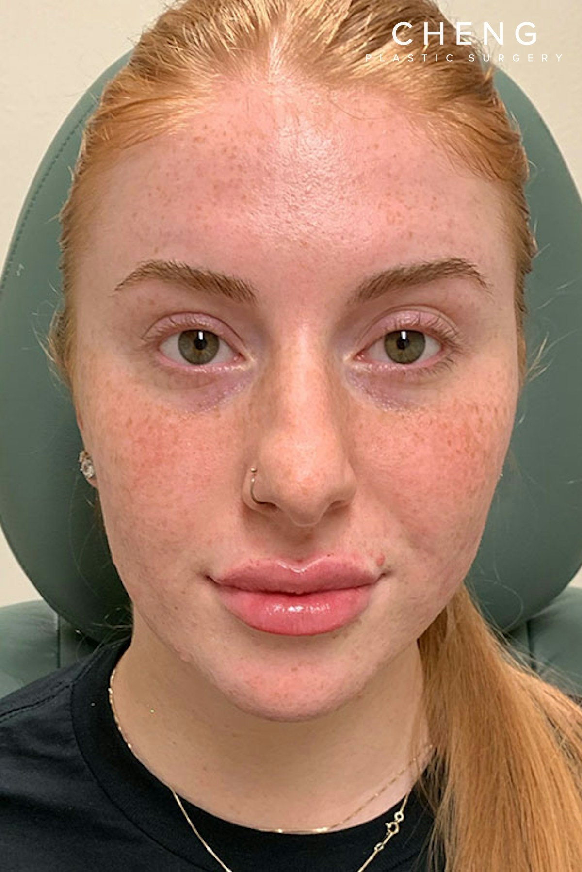 Dermal Fillers Before & After Gallery - Patient 666169 - Image 2