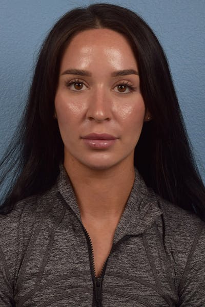 Hidden Patients Before & After Gallery - Patient 725234 - Image 2