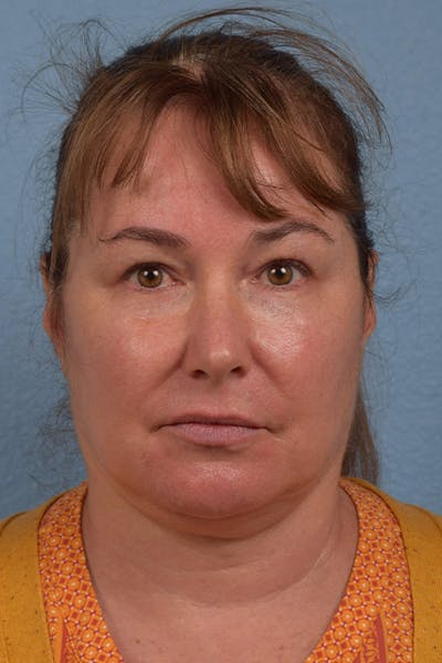 Dermal Fillers Before & After Gallery - Patient 621809 - Image 1