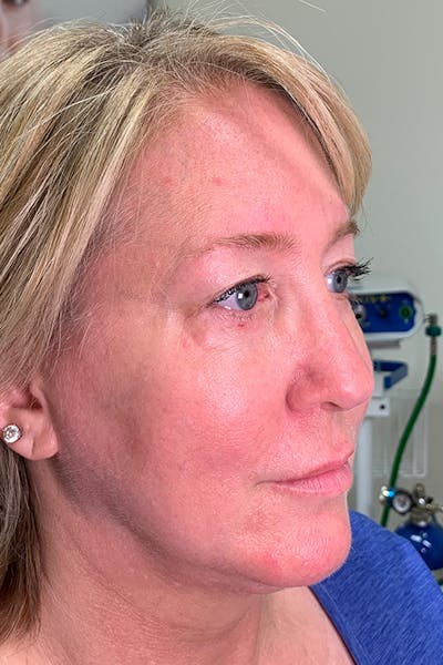 Hidden Patients Before & After Gallery - Patient 176343 - Image 1