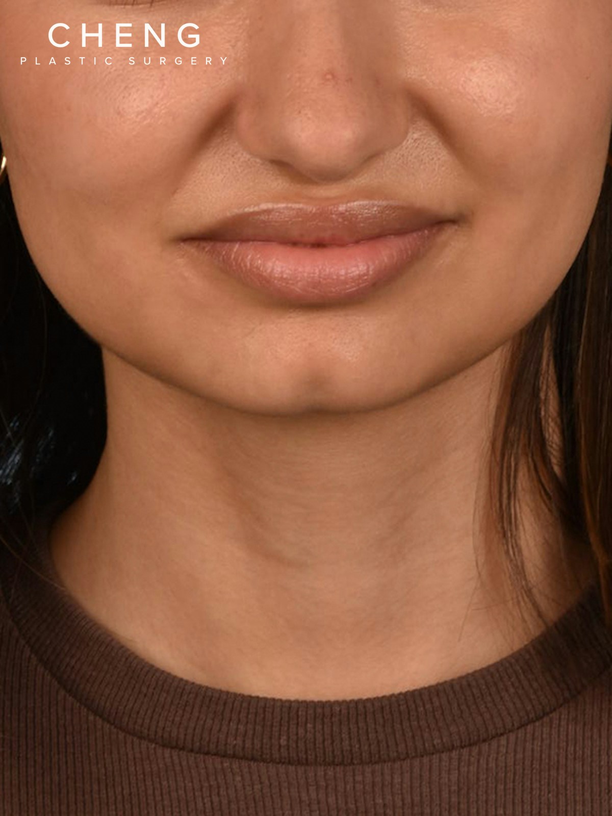 Dermal Fillers Before & After Gallery - Patient 212317 - Image 1