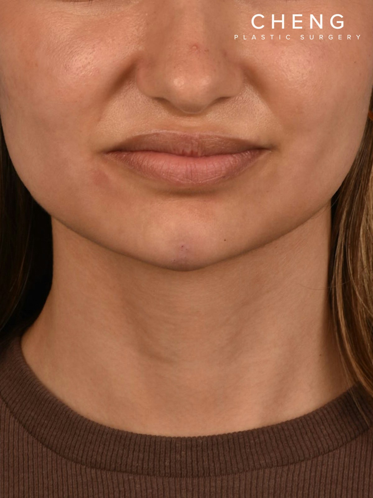 Dermal Fillers Before & After Gallery - Patient 212317 - Image 2