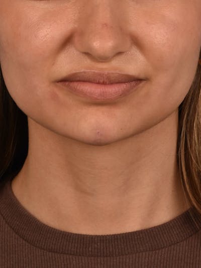 Dermal Fillers Before & After Gallery - Patient 212317 - Image 2
