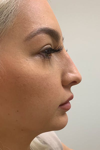 Hidden Patients Before & After Gallery - Patient 324981 - Image 1