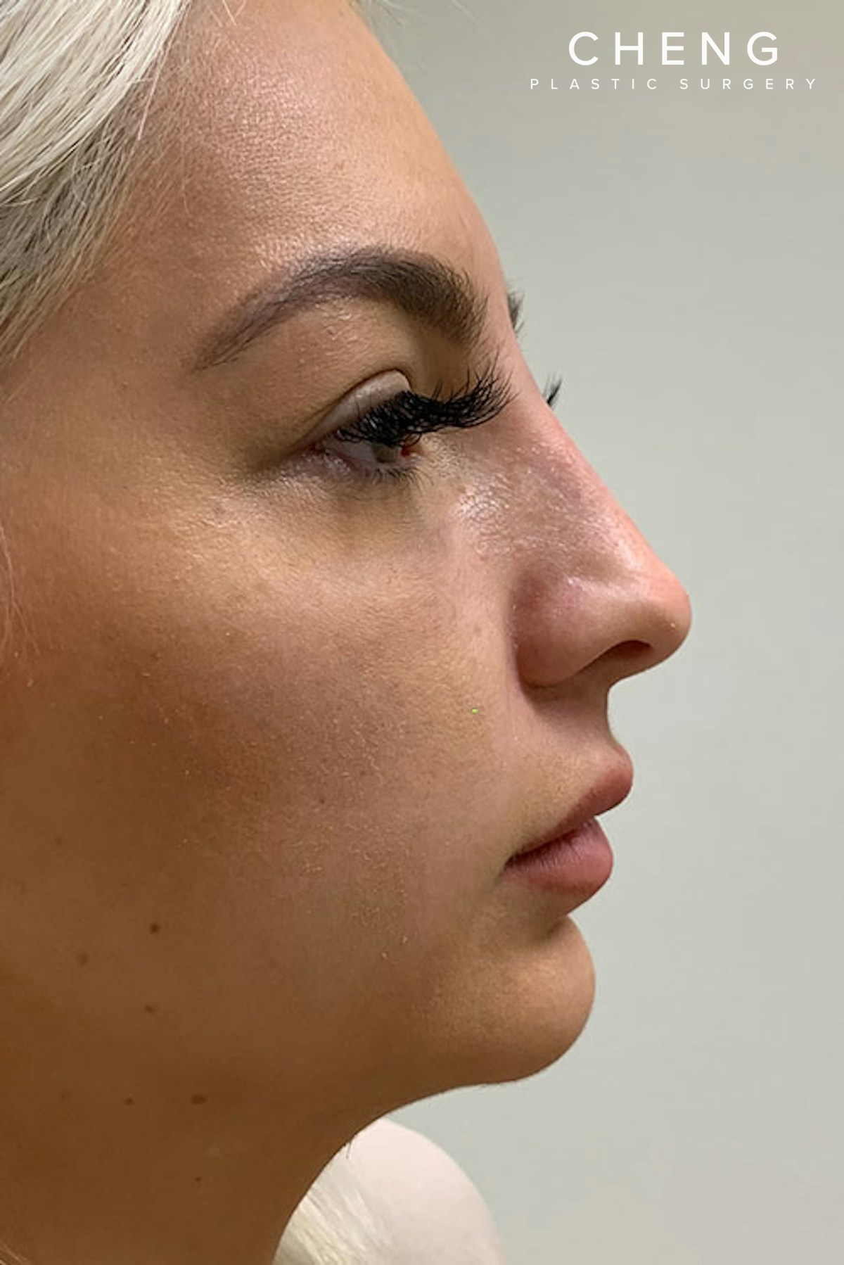 Hidden Patients Before & After Gallery - Patient 324981 - Image 2