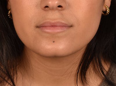 Hidden Patients Before & After Gallery - Patient 708681 - Image 1