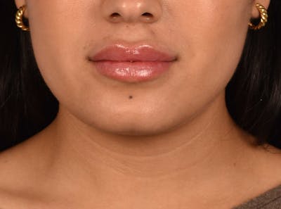 Hidden Patients Before & After Gallery - Patient 708681 - Image 2
