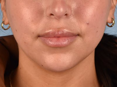 Hidden Patients Before & After Gallery - Patient 230925 - Image 2