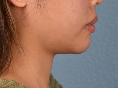 Dermal Fillers Before & After Gallery - Patient 145222 - Image 1