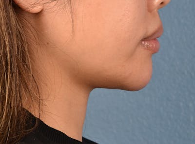 Dermal Fillers Before & After Gallery - Patient 145222 - Image 2