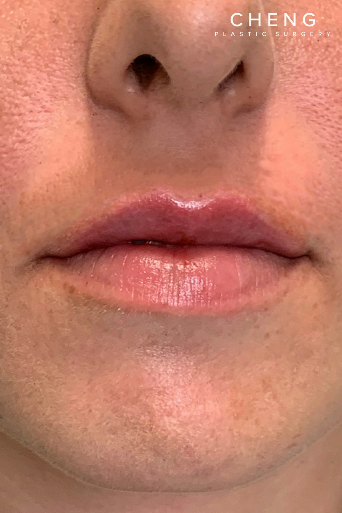 Dermal Fillers Before & After Gallery - Patient 300398 - Image 2
