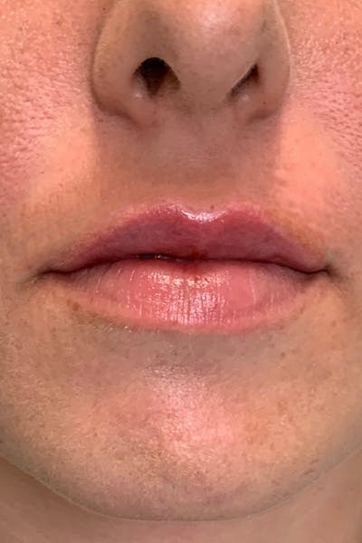 Dermal Fillers Before & After Gallery - Patient 300398 - Image 2