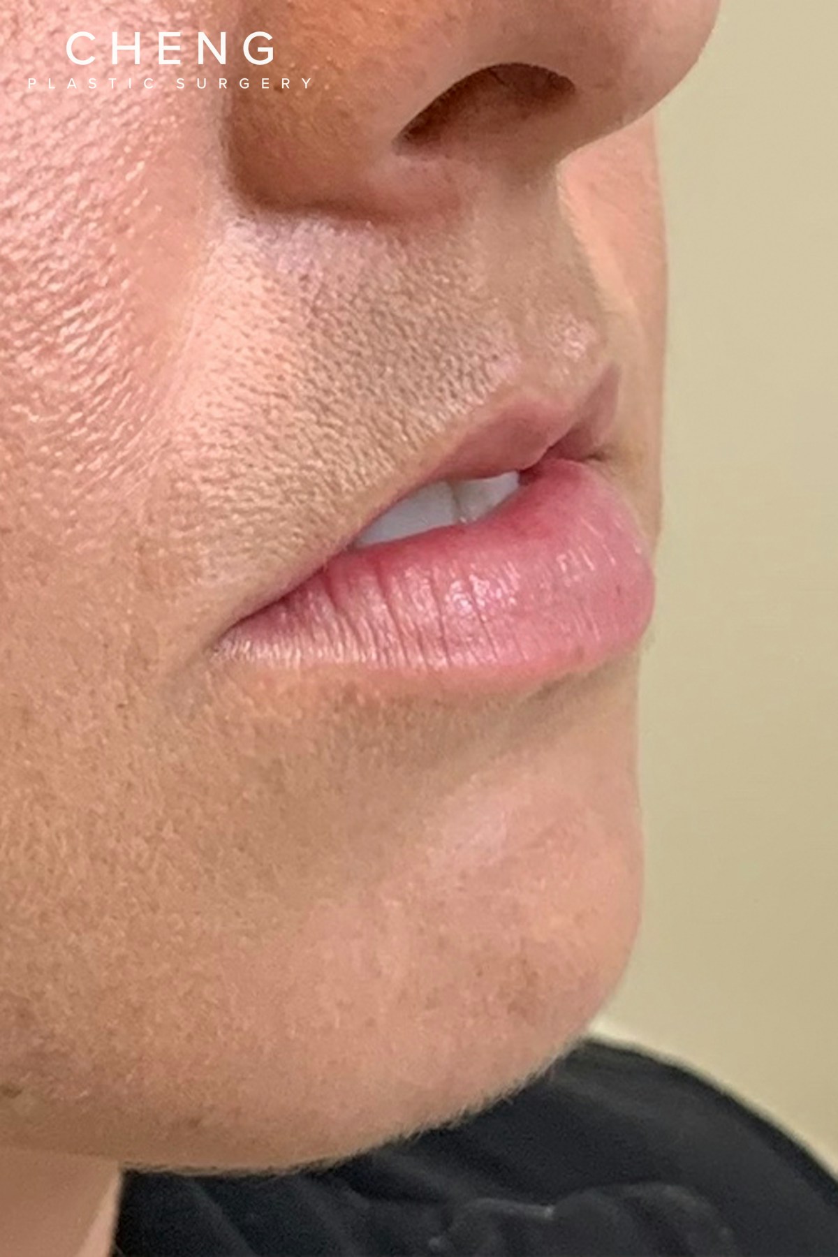 Dermal Fillers Before & After Gallery - Patient 300398 - Image 3