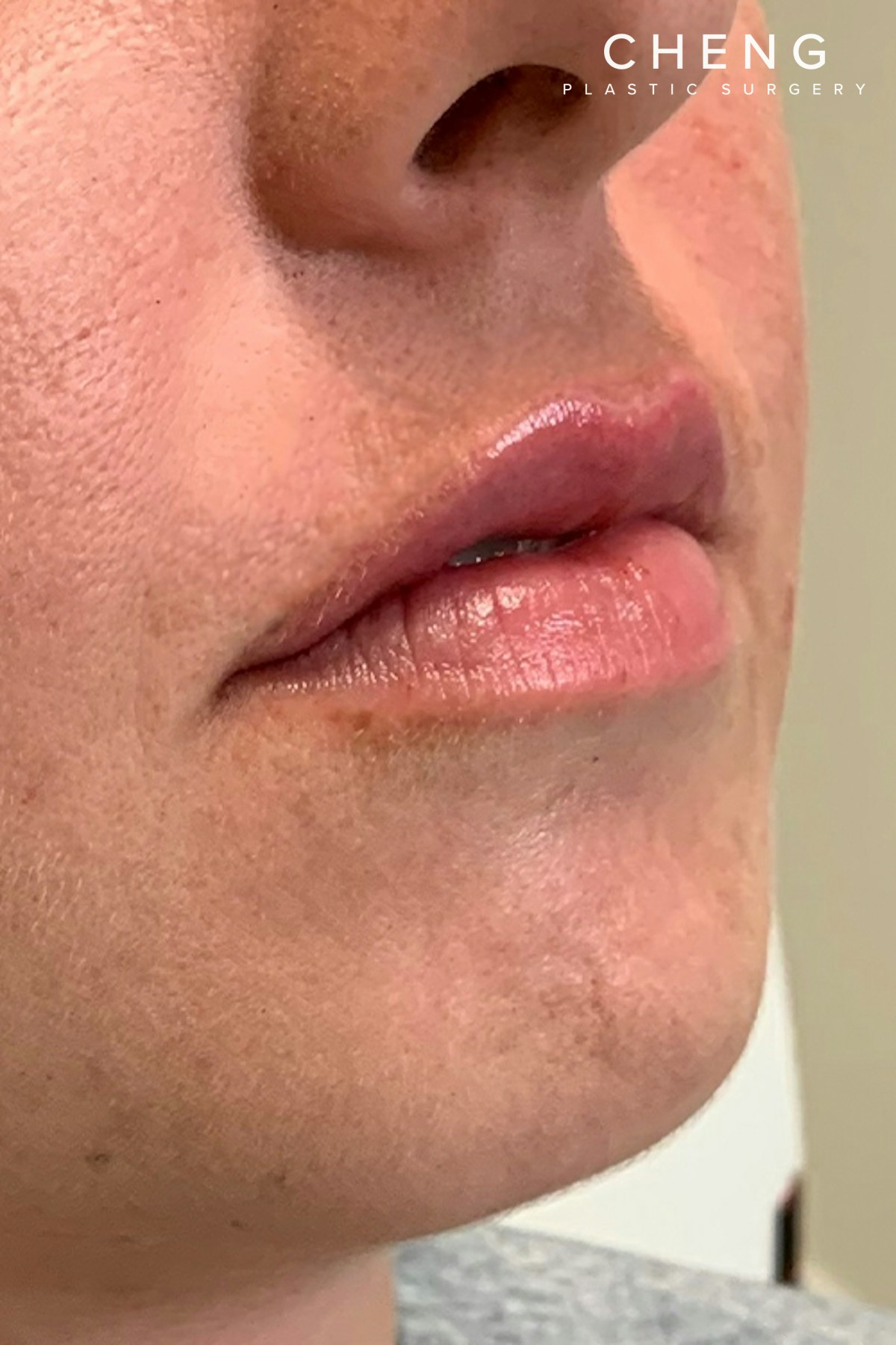 Dermal Fillers Before & After Gallery - Patient 300398 - Image 4