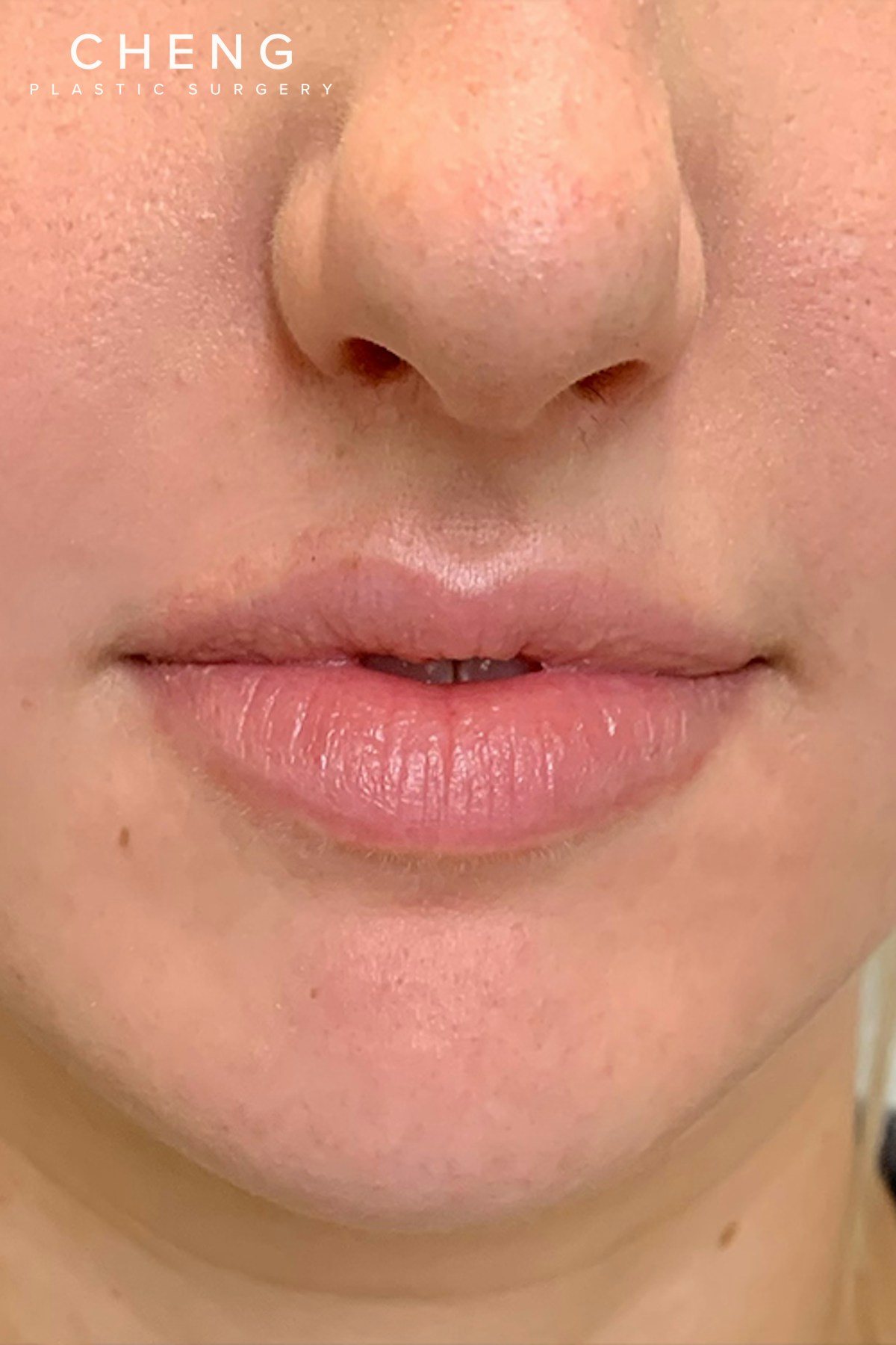 Hidden Patients Before & After Gallery - Patient 150081 - Image 1