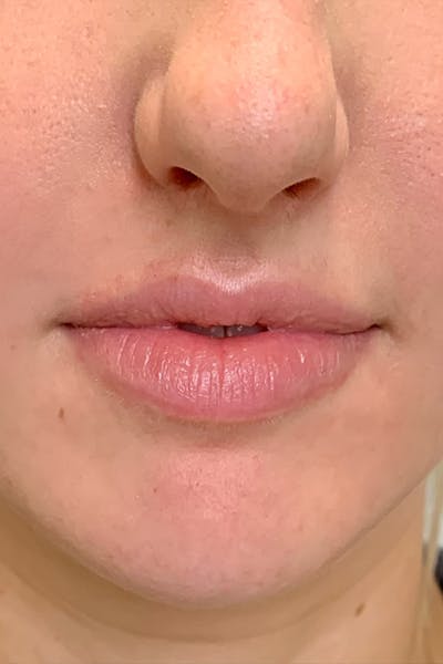 Hidden Patients Before & After Gallery - Patient 150081 - Image 1