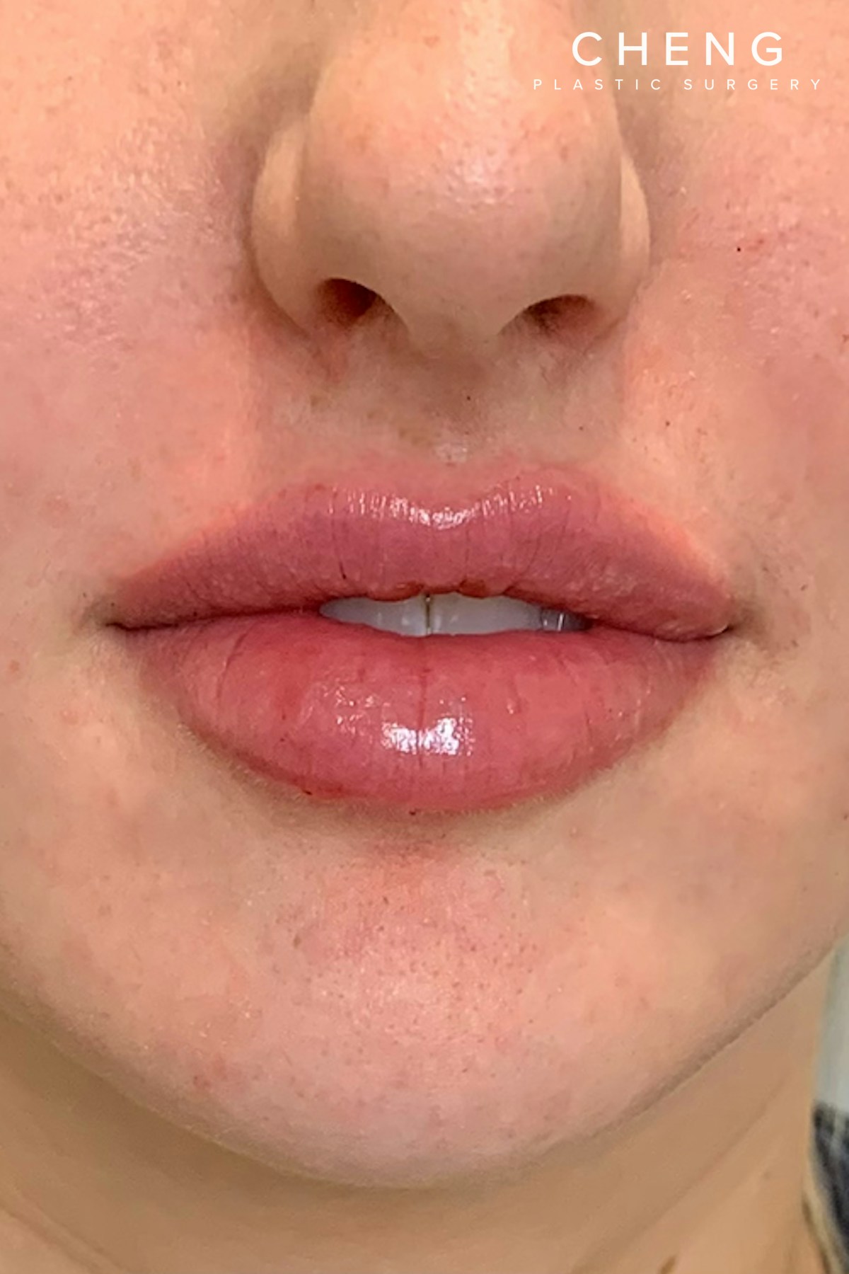 Hidden Patients Before & After Gallery - Patient 150081 - Image 2