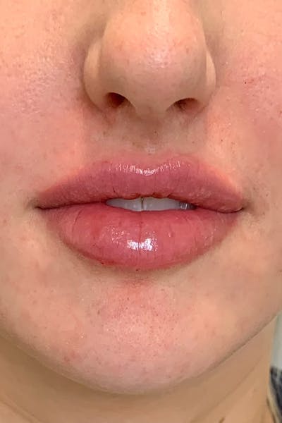 Hidden Patients Before & After Gallery - Patient 150081 - Image 2