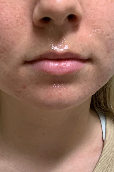 Dermal Fillers Before & After Gallery - Patient 222622 - Image 1