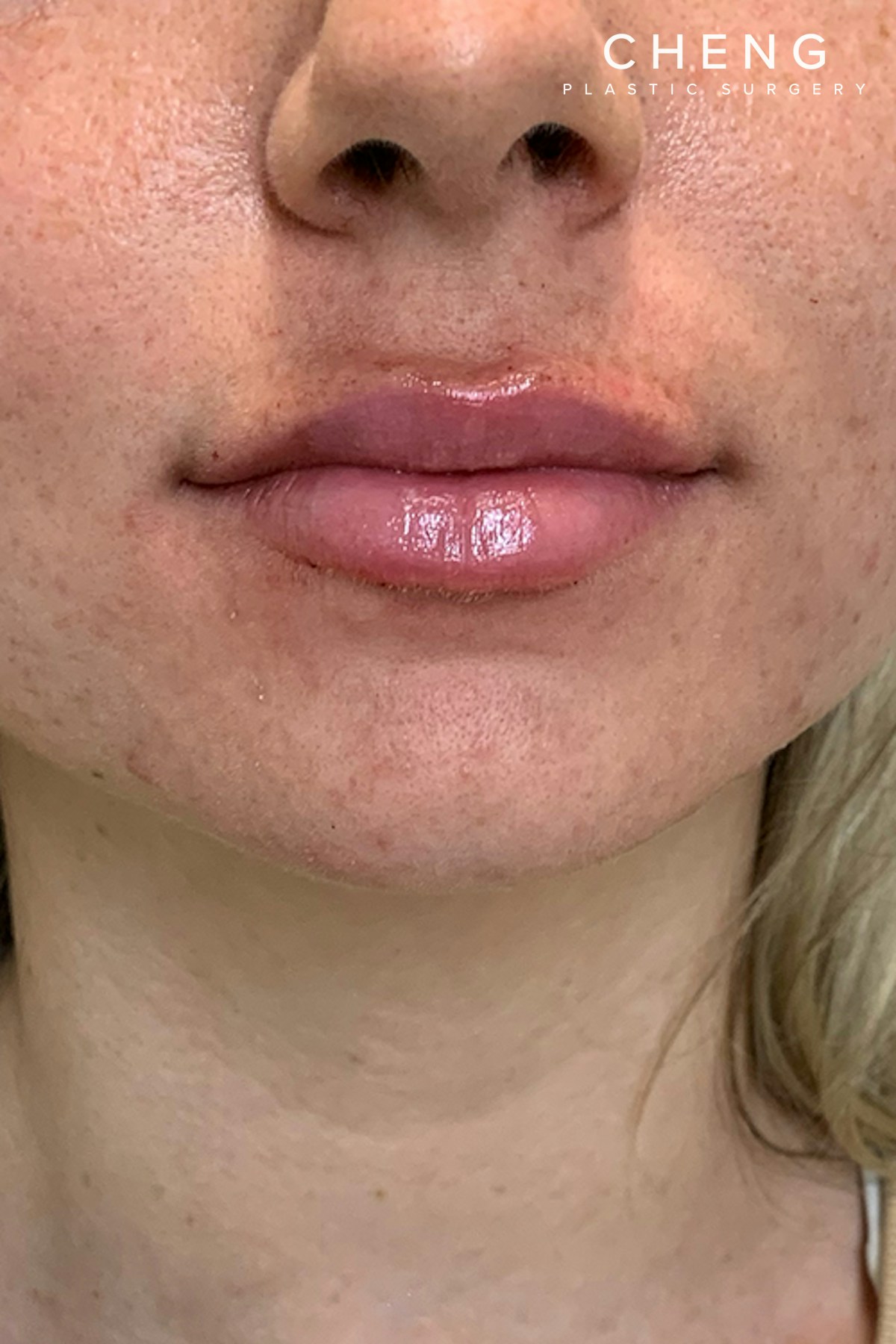 Dermal Fillers Before & After Gallery - Patient 222622 - Image 2