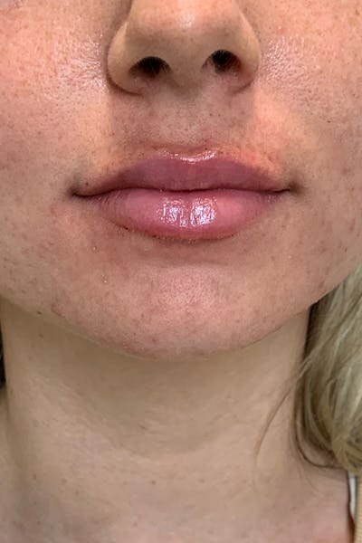 Dermal Fillers Before & After Gallery - Patient 222622 - Image 2