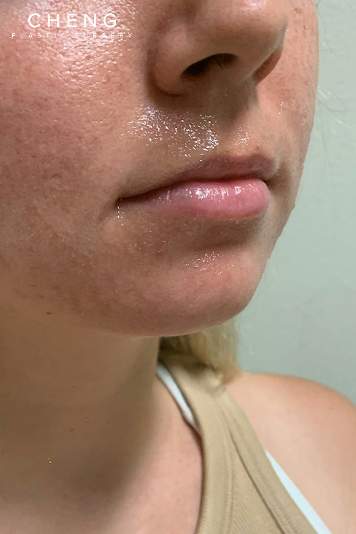 Dermal Fillers Before & After Gallery - Patient 222622 - Image 3