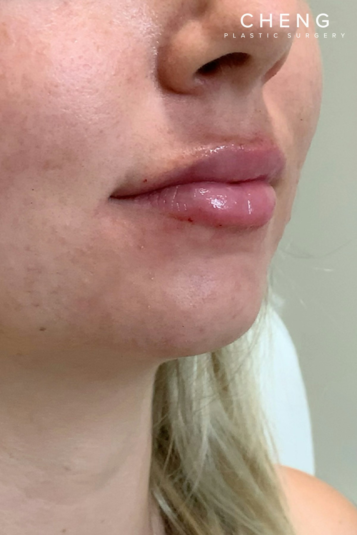 Dermal Fillers Before & After Gallery - Patient 222622 - Image 4