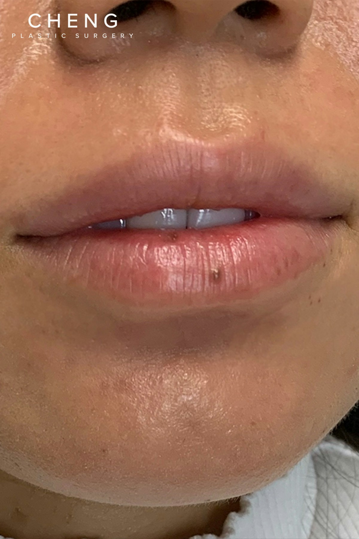 Hidden Patients Before & After Gallery - Patient 188403 - Image 1