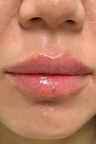 Hidden Patients Before & After Gallery - Patient 188403 - Image 2