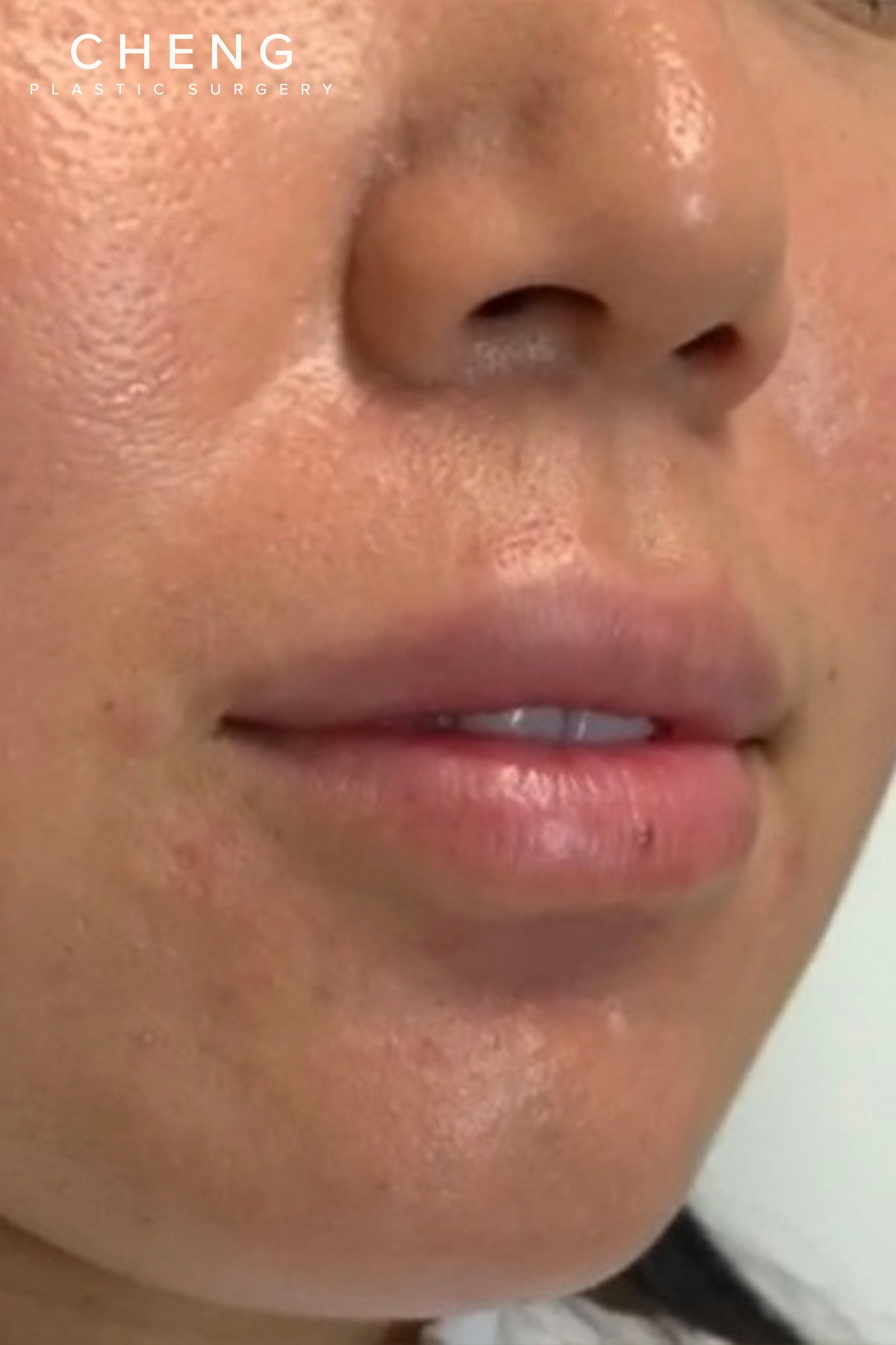 Hidden Patients Before & After Gallery - Patient 188403 - Image 3